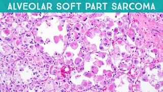 Alveolar soft part sarcoma explained in 5 minutes basic soft tissue pathology [upl. by Plusch73]