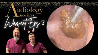 SOFT EAR WAX PLUG REMOVAL  WAXVENT 2 [upl. by Eivod922]