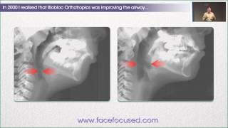 The Case for Biobloc Improving the Airway  William M Hang DDS MSD [upl. by Ramuk]