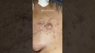 Blackheads blackheads treatments sacdepspa [upl. by Kiele607]