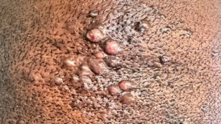 💜Ingrown hairs and bumps after haircuts skincare haircut skincare barberlife [upl. by Izabel]