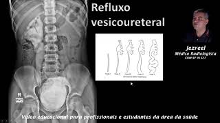 Refluxo vesico ureteral [upl. by Weissberg]