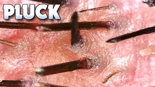 Dr Poppers Plucking Hair Up Close Popping Pimples Skin Microscope [upl. by Llerrac]