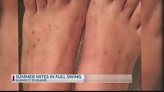 Chigger bite infestation in East Texas [upl. by Haramat774]