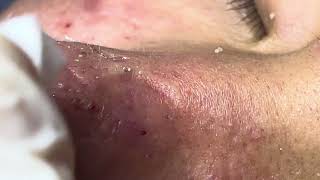 Acne treatment Thu 90 Da Nang  new 112024 [upl. by Barcus]