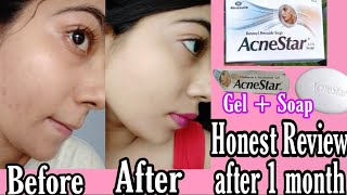 Acnestar Gel and Soap  Waste of money Honest review after 1 month skincare acne acnestar [upl. by Aliled]