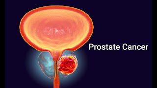 prostate cancer 5 biopsy technique Gleason pattern Gleason score grading system and staging [upl. by Asi]