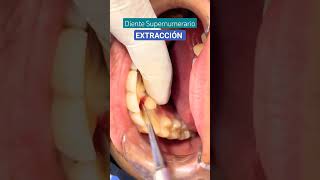 EXTRACCIÓN DENTAL de Diente Supernumerario doctor dentist urgencias enfermeria odontologia [upl. by Elletnohs]