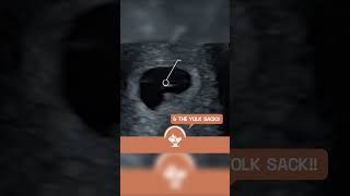 Yolk Sack and Heartbeat at 6 weeks Pregnancy EarlyDetection ViabilityScan [upl. by Yanrahc818]