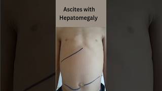 Ascites with Hepatomegaly causes medicine hepatitis ascites [upl. by Pattin948]