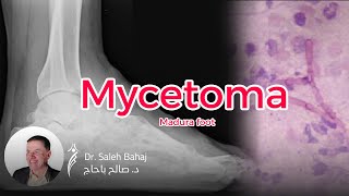 13 Mycetoma Madura foot [upl. by Allehc]