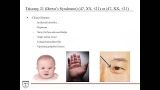 Aneuploidies Trisomy 13 18 21 Turner Syndrome Klinefelter Syndrome Genetics 6 of 8 [upl. by Verdha]