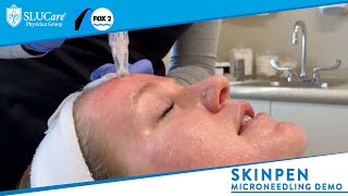 Skinpen Microneedling How it Works amp Demonstration  SLUCare MedSpa [upl. by Lizzie]