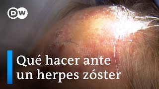 Primero varicela luego herpes zóster [upl. by Anawak]