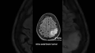 Intraxial vs extra axial [upl. by Ellehcear]