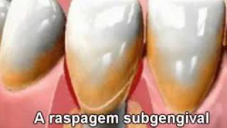 Periodontia Doença Periodontal Gengiva Retração Gengival Espaço Perio Odontologia [upl. by Einnus641]