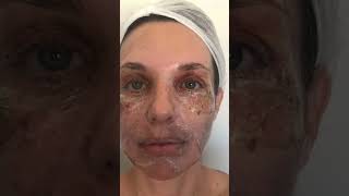 Peeling de fenol  evolução 14 dias fenol peelingdefenol dermatologia personadermatologia [upl. by Allyson]