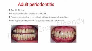 New classification of periodontal diseases Prof Dr Enas Elgendy [upl. by Mulac]