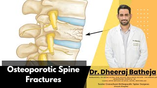 Transform Your Understanding of Osteoporotic Spine Fractures with Dr Dheeraj Batheja [upl. by Caitrin]