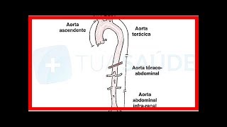 Symptome Ursachen und Behandlung von Aortenaneurysma [upl. by Geiss]