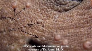 Molluscum contagiosum vs HPV warts on same patient combination infection [upl. by Magdala]