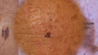 Difficult seborrheic keratoses  Dr Caterina Longo [upl. by Ahsekram]