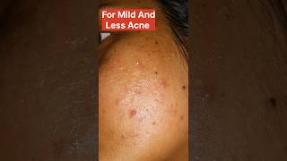 how to treat acne pimples azelaic acid or glocin gel which is better acnetreatment azelaicacid [upl. by Viviene]