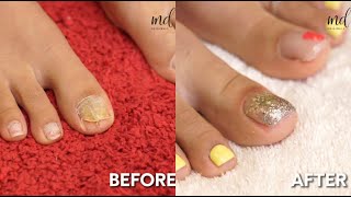 PEDICURE TRANSFORMATION [upl. by Powder]