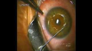 Dr Riad Fikry  Simultaneous Corneal Ring Segment Insertion and Corneal Crosslinking [upl. by Ayoral503]