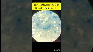 Sputum AFB Test Positive  Slide Microscopic View [upl. by Sgninnej]