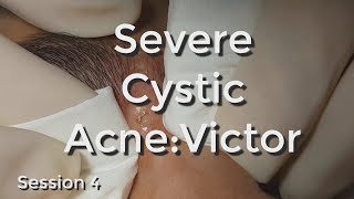 Severe Cystic Acne  Victor Session 4 [upl. by Florian]