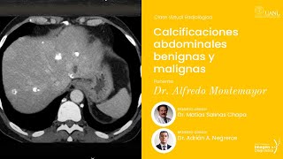 Calcificaciones abdominales benignas y malignas por el Dr Alfredo Montemayor Elizondo [upl. by Bahr]