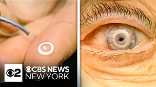 I DID THE FIRST ARTIFICIAL CORNEAL IMPLANT in New York  Dr Ilan Cohen in CBS2 News [upl. by Alim]