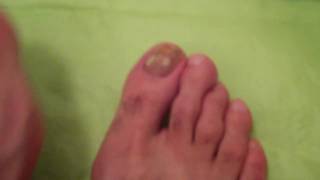 TOENAIL FUNGUS DOCUMENTARY DAY 1 [upl. by Costanza892]