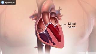 Insuficiência mitral 2 [upl. by Eulalee]