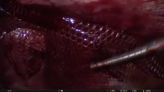 Laparoscopic Ventral Hernioplasty 24 Uzma [upl. by Kentiga413]