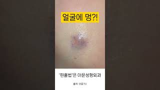 얼굴에 멍 피부종양 모기질종 핀홀법 수술 병원 pilomatricoma skin tumor surgery scar seoul korea hospital아문TV [upl. by Gasperoni]