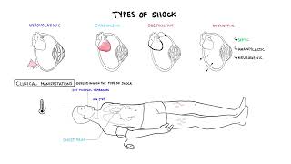 Approach to Shock  types hypovolemic cardiogenic distributive anaphylaxis pathology treatment [upl. by Cannon]