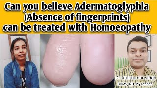 adermatoglyphia Absence of fingerprints can be treated by Homoeopathic intervention [upl. by Jourdan242]