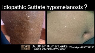 White spots on skin in old age idiopathic guttate hypomelanosis Treatment and prevention [upl. by Nirrac]