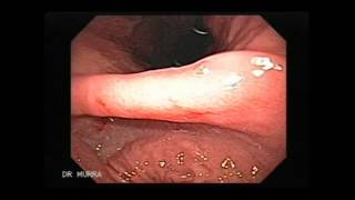 Video clip of an Upper Endoscopy [upl. by Zeena109]