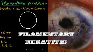 Filamentary Keratitis  Ophthalmology [upl. by Adnuahsal]