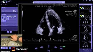 Piedmont Healthcare Left Ventricle Myocardial Strain Workflow on Siemens SC2000 [upl. by Ttocserp893]