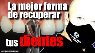 LOS IMPLANTES DENTALES CAMBIARON ¿LO SABÍAS [upl. by Yeblehs]