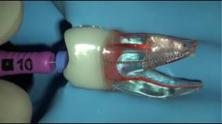 Cleaning and shaping root canals using the iRace sequence [upl. by Eirene]