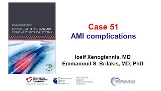 Case 51 PCI Manual  MI complications [upl. by Ijuy]