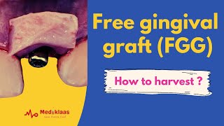 Free gingival graft  The technique [upl. by Enyala]