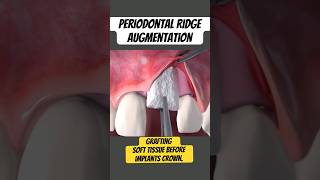 Ridge Augmentation Soft tissue Grafting Dental Implants [upl. by Arita]