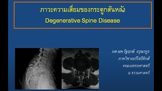 Degenerative Lumbar Spine disease ภาวะกระดูกสันหลังบริเวณเอวเสื่อม อ รัฐฤกษ์ 20190716 [upl. by Iznekcam]