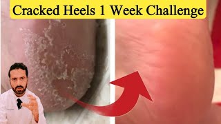 Cracked Heels 1 Week Solution  Quick Cracked Heel Treatment [upl. by Nylla47]